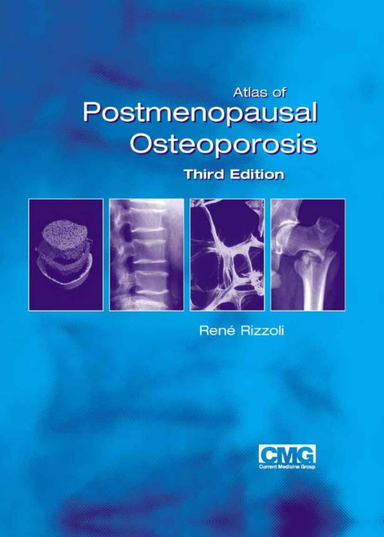 Atlas of Postmenopausal Osteoporosis, 3rd Edition